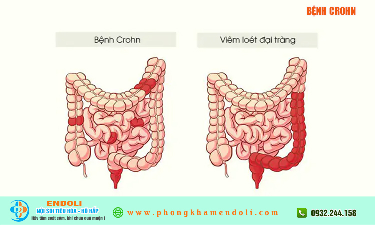 Bệnh Crohn là bệnh gì?