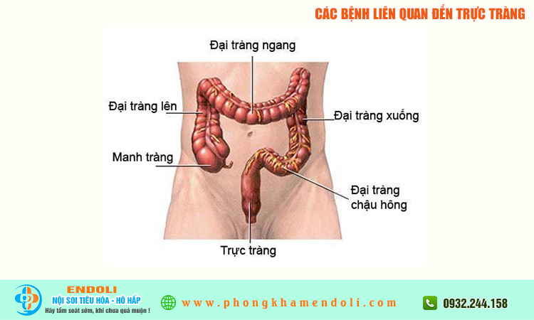 Các bệnh liên quan đến trực tràng