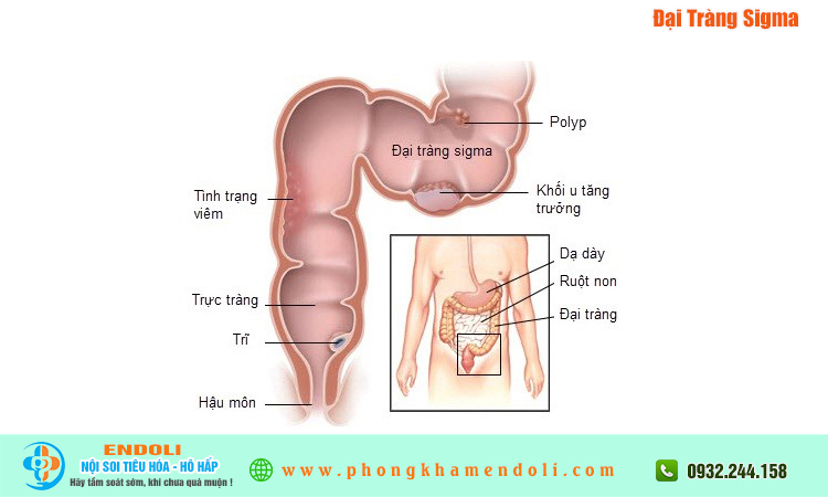 Đại Tràng Sigma là gì?