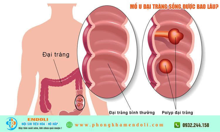 Mổ U Đại Tràng Sống Được Bao Lâu