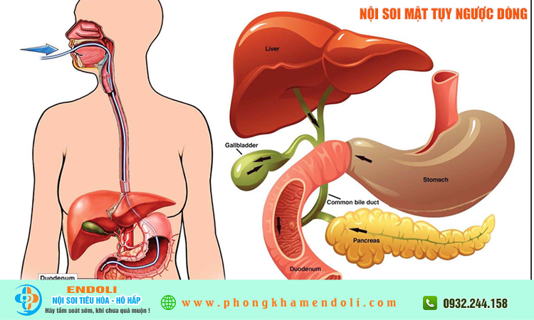 Nội soi mật tuỵ ngược dòng