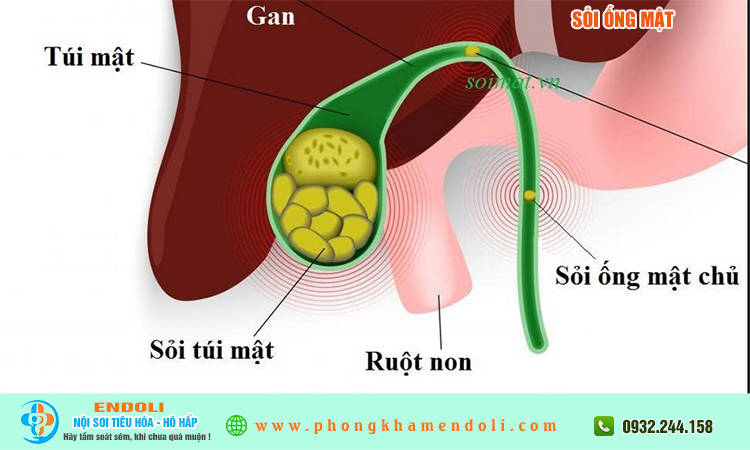 Sỏi ống mật