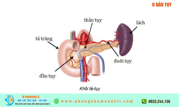 U đầu tụy