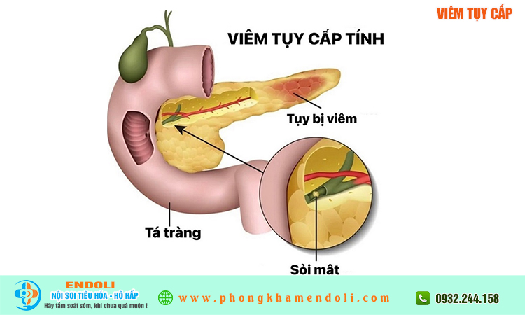 Viêm tụy cấp