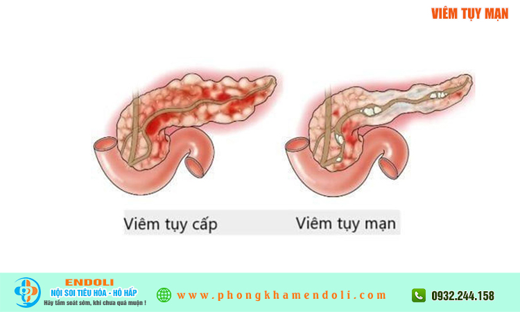 Viêm tụy mạn