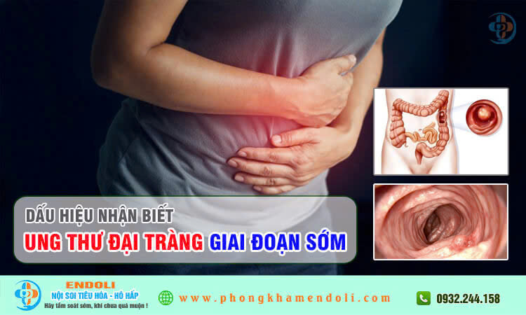 Dấu hiệu ung thư đại tràng giai đoạn đầu